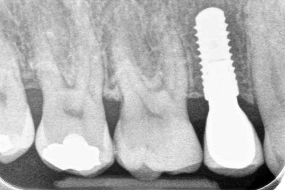 reslts from dental implant crown