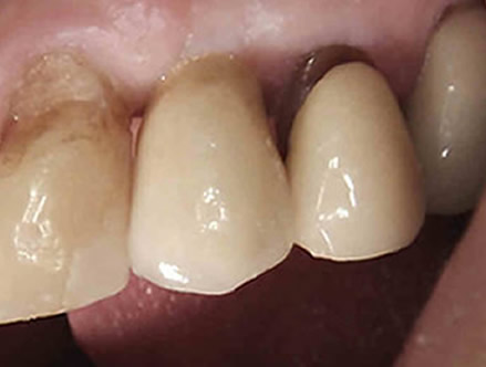 lovely tooth after dental implants