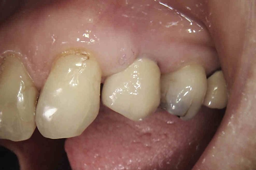 results from anterior dental implant